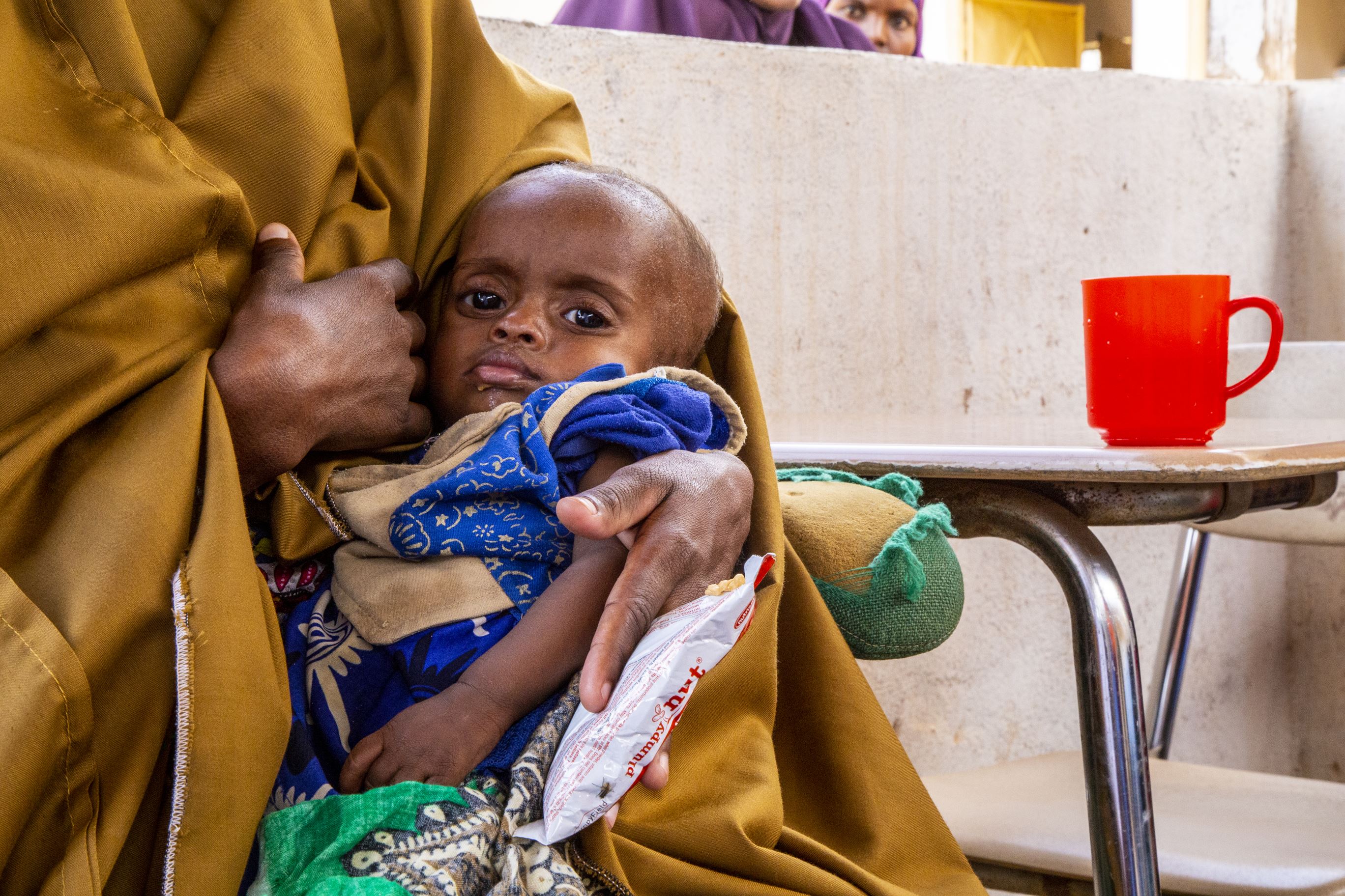 A mother holds her malnourished baby