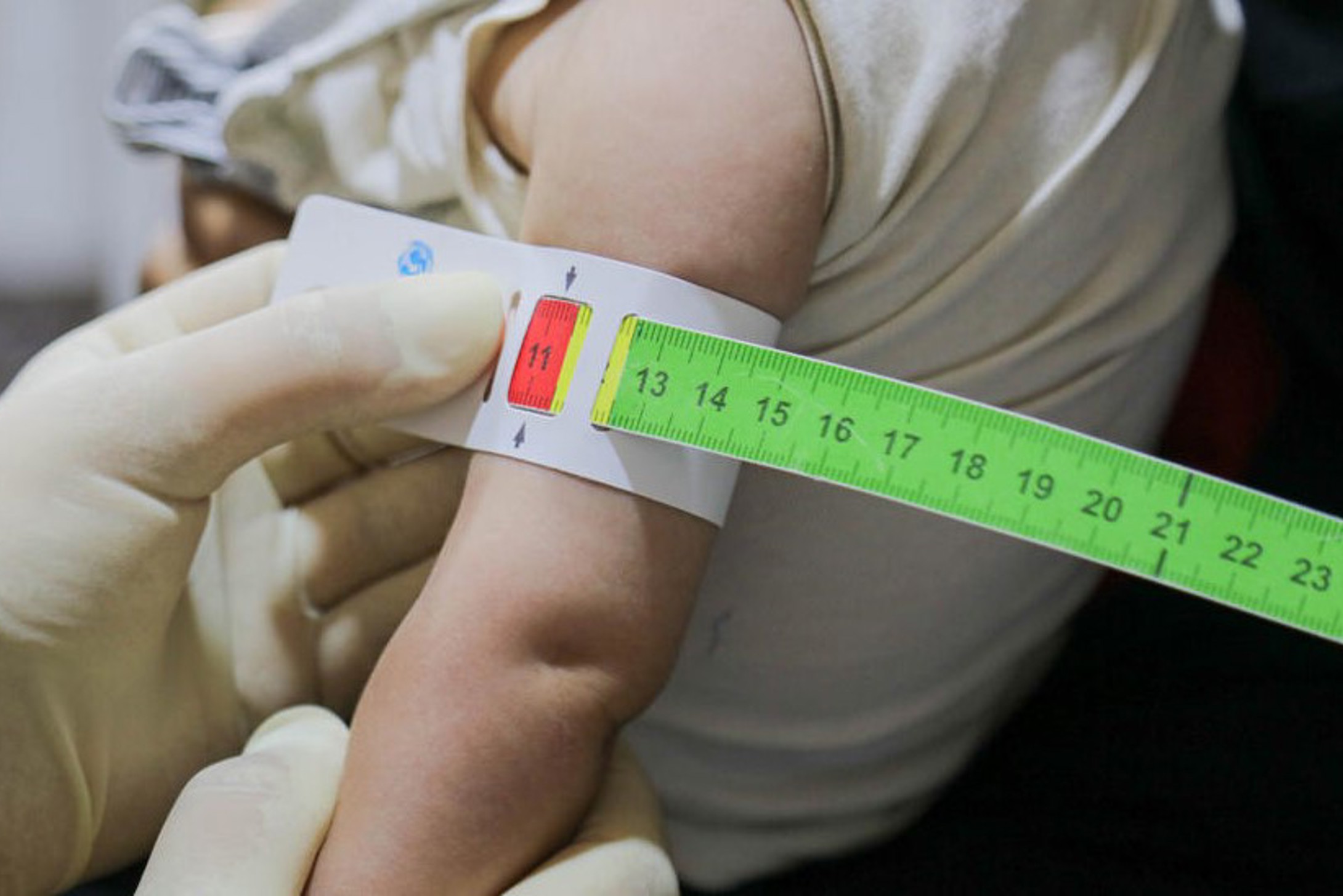 Overcoming child malnutrition | World Vision UK